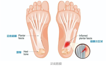 足底筋膜炎，一种常见的足部疾病