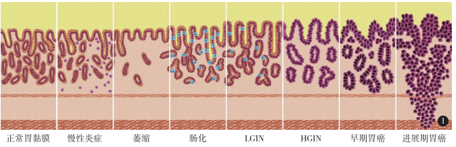 肠上皮化生是什么意思图片
