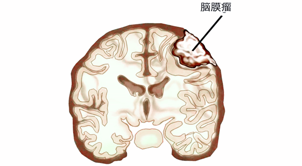 脑膜瘤示意图图片