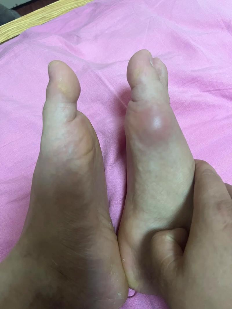 突然脚痛,小心痛风