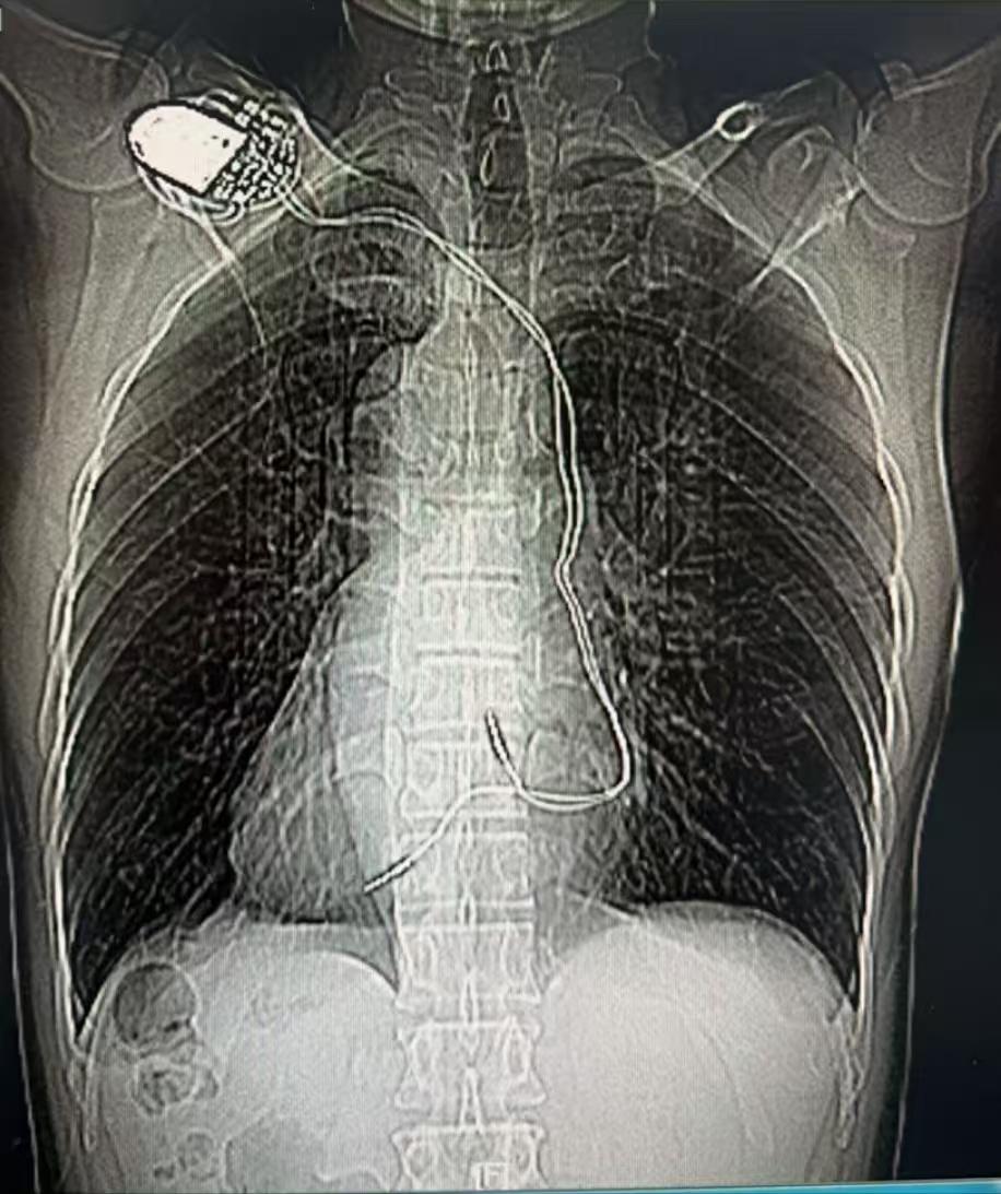 罕见"右位心"房颤,ice指导下成功射频消融治疗